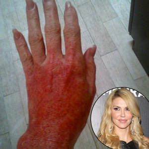 Brandi Glanville, Burned Hand Brandi Glanville, Burned Hand
